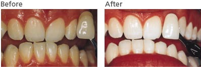 Teeth whitened with Casan Whitening