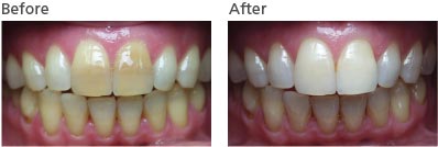 Teeth whitened with Moore Whitening