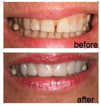 Teeth improved with Veneers